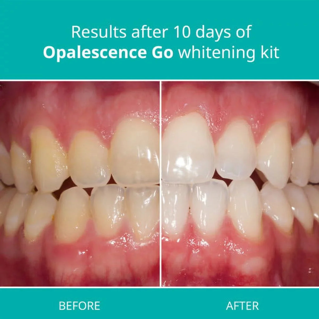 Opalescence Toothpaste And Opalescence Go 10% Mint Ivoryning Trays